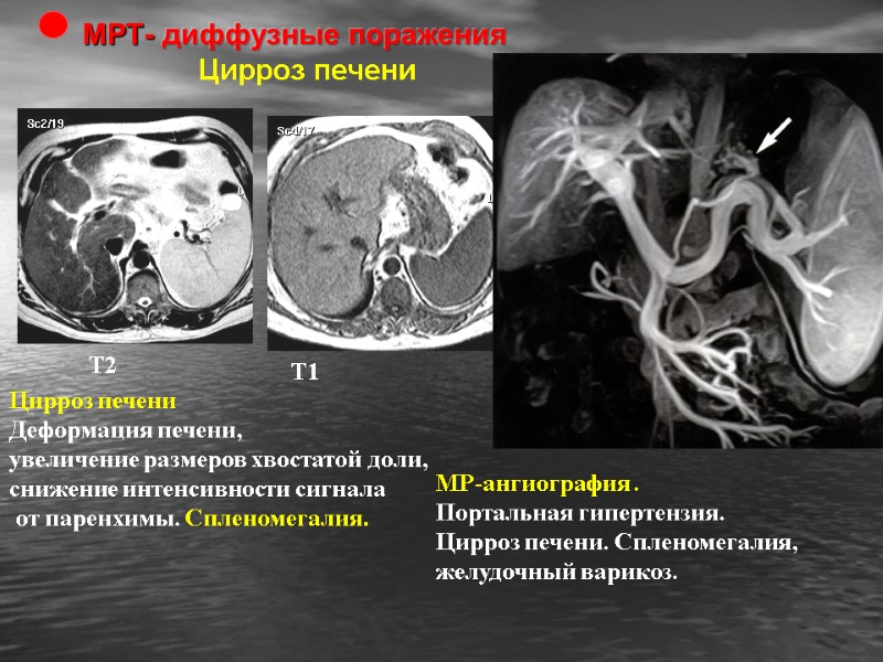 Т2 Т1 МР-ангиография .  Портальная гипертензия. Цирроз печени. Спленомегалия,    